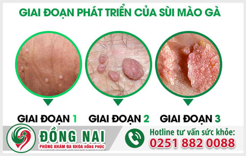 Sùi mào gà có tự hết được không?