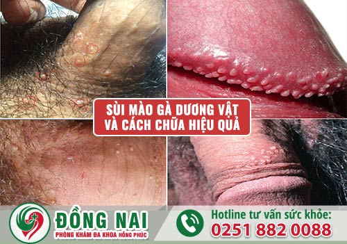 Sùi mào gà dương vật và cách chữa hiệu quả