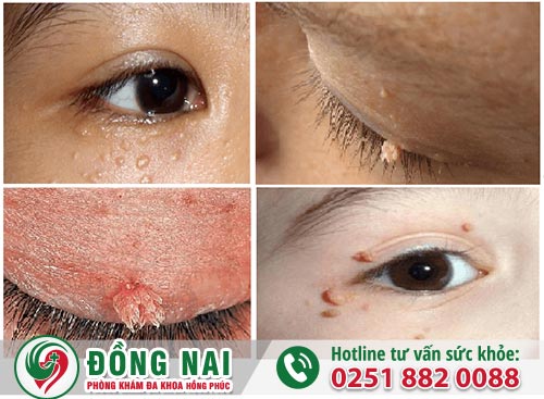 Sùi mào gà ở mắt - Bệnh lý nguy hiểm chớ dại mà chủ quan