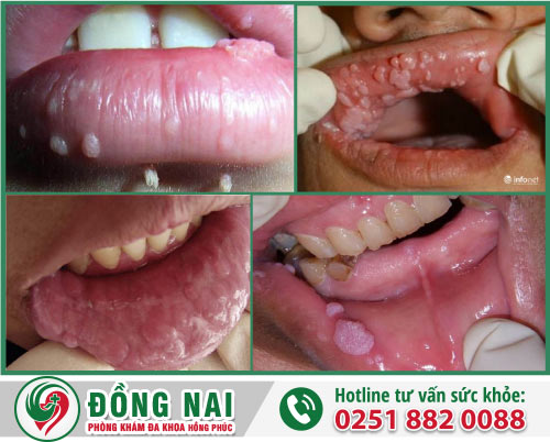Bạn cần biết gì về sùi mào gà ở miệng?