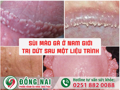 Bệnh sùi mào gà ở nam giới, trị dứt sau một liệu trình