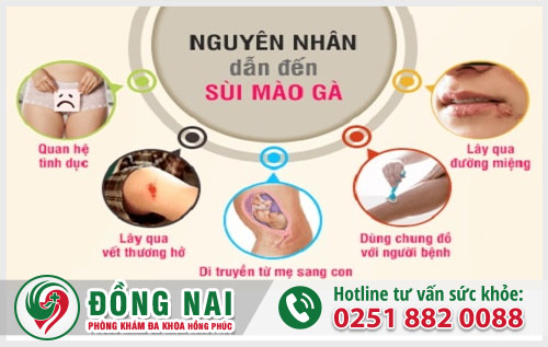 Sùi mào gà ở nữ giới, nguyên nhân và cách điều trị