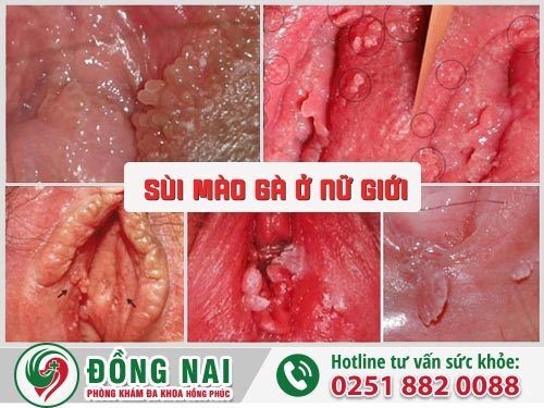 Sùi mào gà ở nữ giới, nguyên nhân và cách điều trị