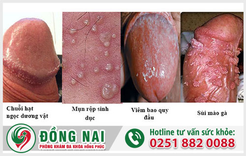 Thân dương vật mọc mụn có phải mắc bệnh xã hội?