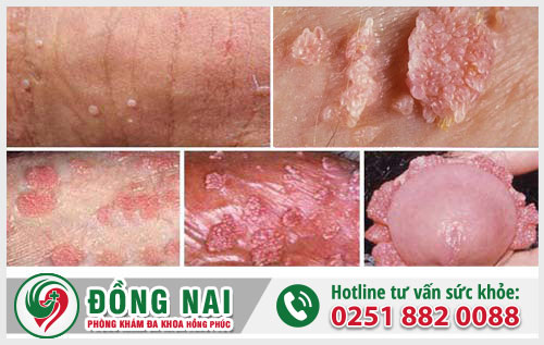Thân dương vật mọc mụn có phải mắc bệnh xã hội?