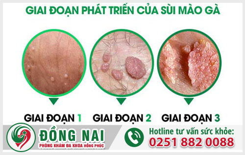 Thời gian chữa sùi mào gà bao lâu thì khỏi?