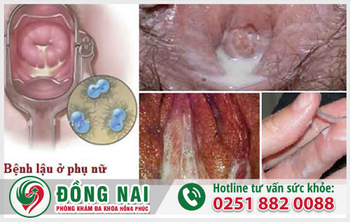 Thận trọng chứng tiểu buốt ở nữ giới