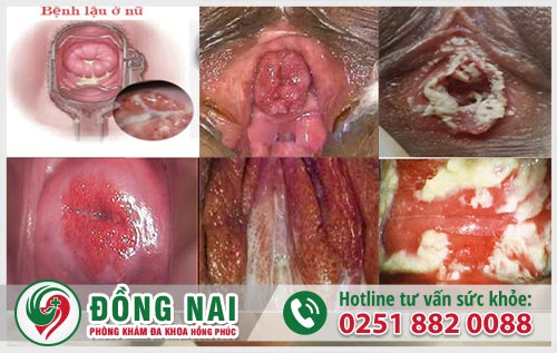 Tiểu khó ở nữ giới là dấu hiệu bệnh gì? Nguy hiểm không?