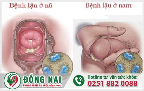 Đi tiểu rát buốt có mủ là dấu hiệu của bệnh gì?