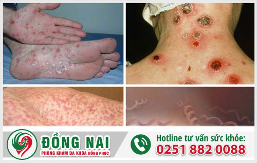 Tư vấn bệnh xã hội đáng tin cậy ở Biên Hòa – Đồng Nai