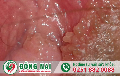 U nhú âm đạo là dấu hiệu bệnh gì?