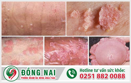U nhú dương vật là dấu hiệu cảnh báo bệnh gì?