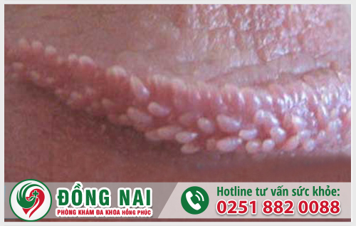 U nhú dương vật là dấu hiệu cảnh báo bệnh gì?