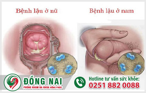 Bệnh lậu - Nguyên nhân gây viêm vùng kín