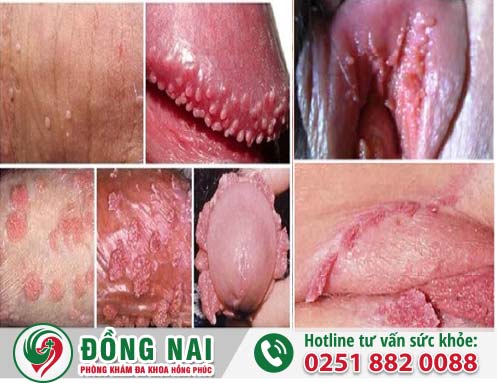 Virus HPV là gì?