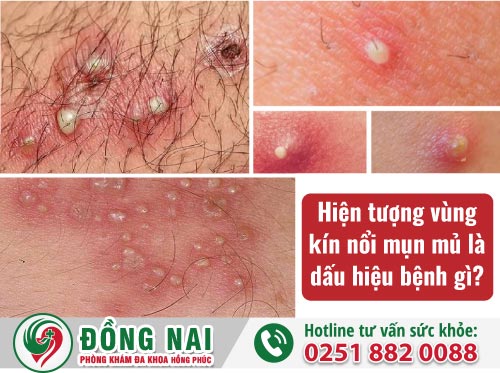 　　Hiện tượng vùng kín nổi mụn mủ là dấu hiệu bệnh gì?